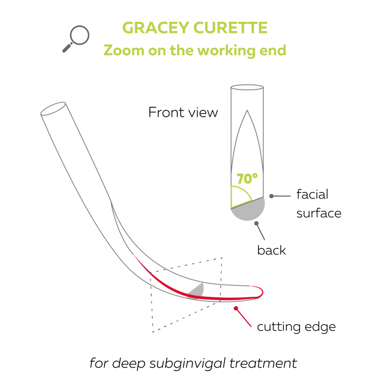 Periodontal curettes focus on Gracey curettes • Dental hand instruments